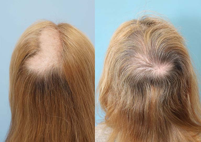 HỘI CHỨNG NHỔ TÓC – ĂN TÓC: Bệnh Lý Xung Động Tâm Thần*, Không Phải “Thói Quen Xấu”